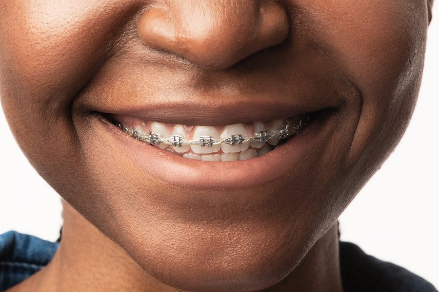 Traditional Braces at Orthodontist Kennesaw