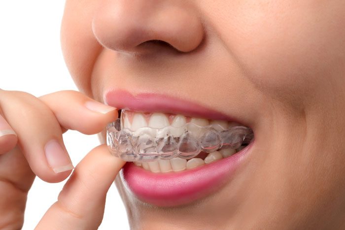 Clear Aligners at Orthodontist Kennesaw