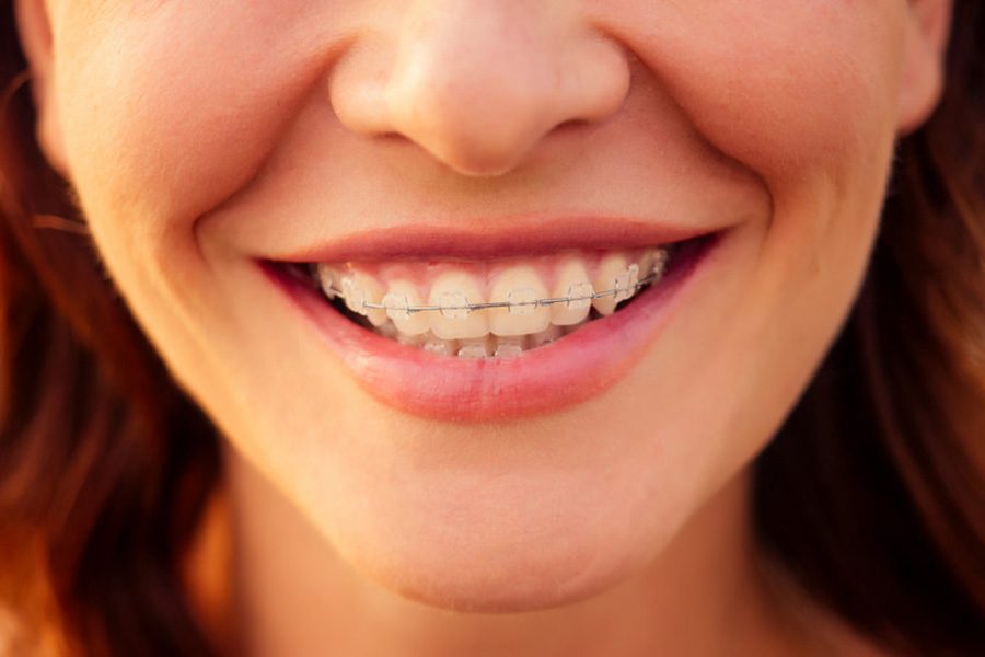 Cosmetic Braces at Orthodontist Kennesaw
