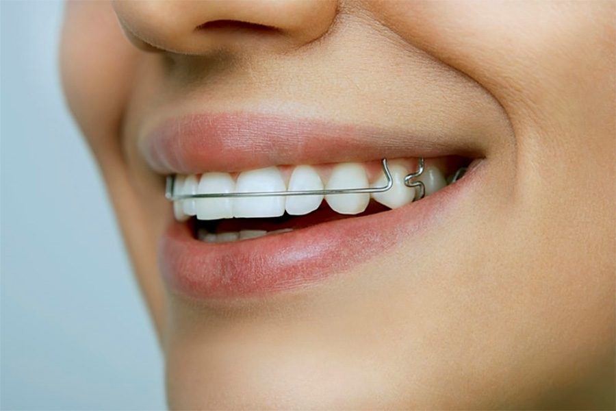 Retainers at Orthodontist Kennesaw