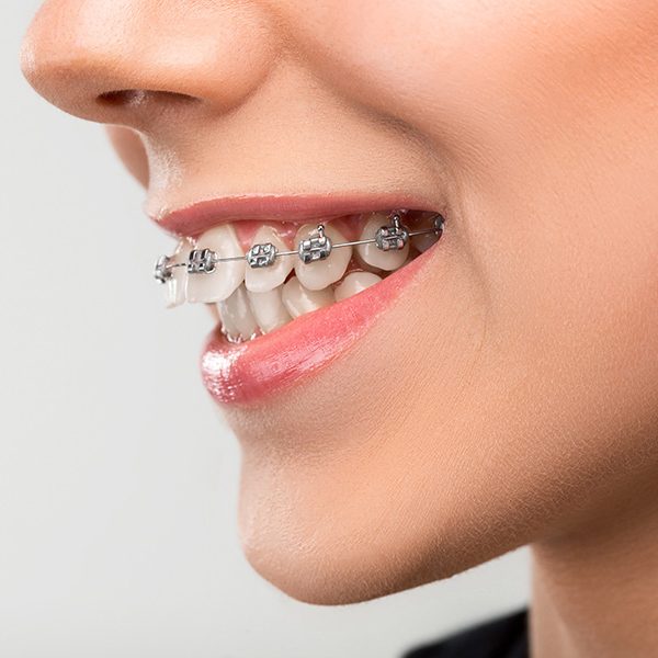 Teen with Traditional Braces