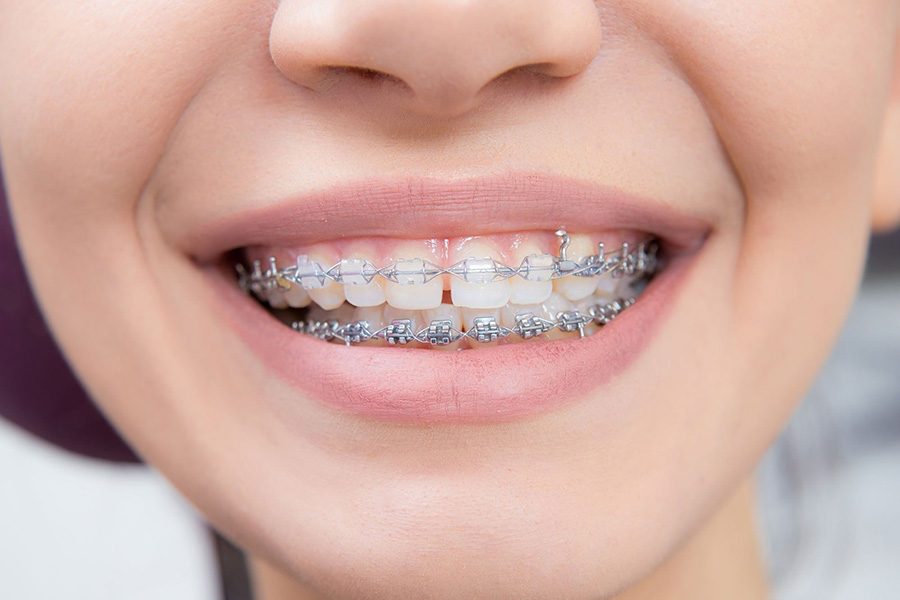 Clear Braces at Orthodontist Kennesaw
